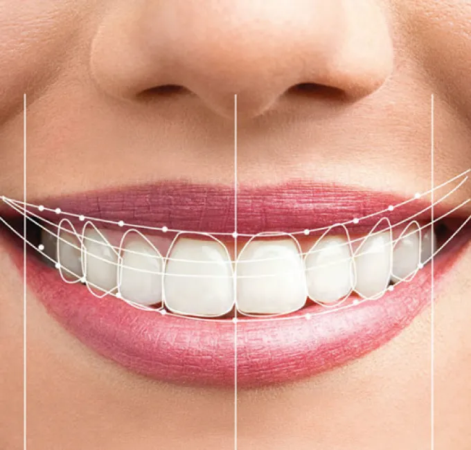 Pre-wedding smile makeover Jaipur